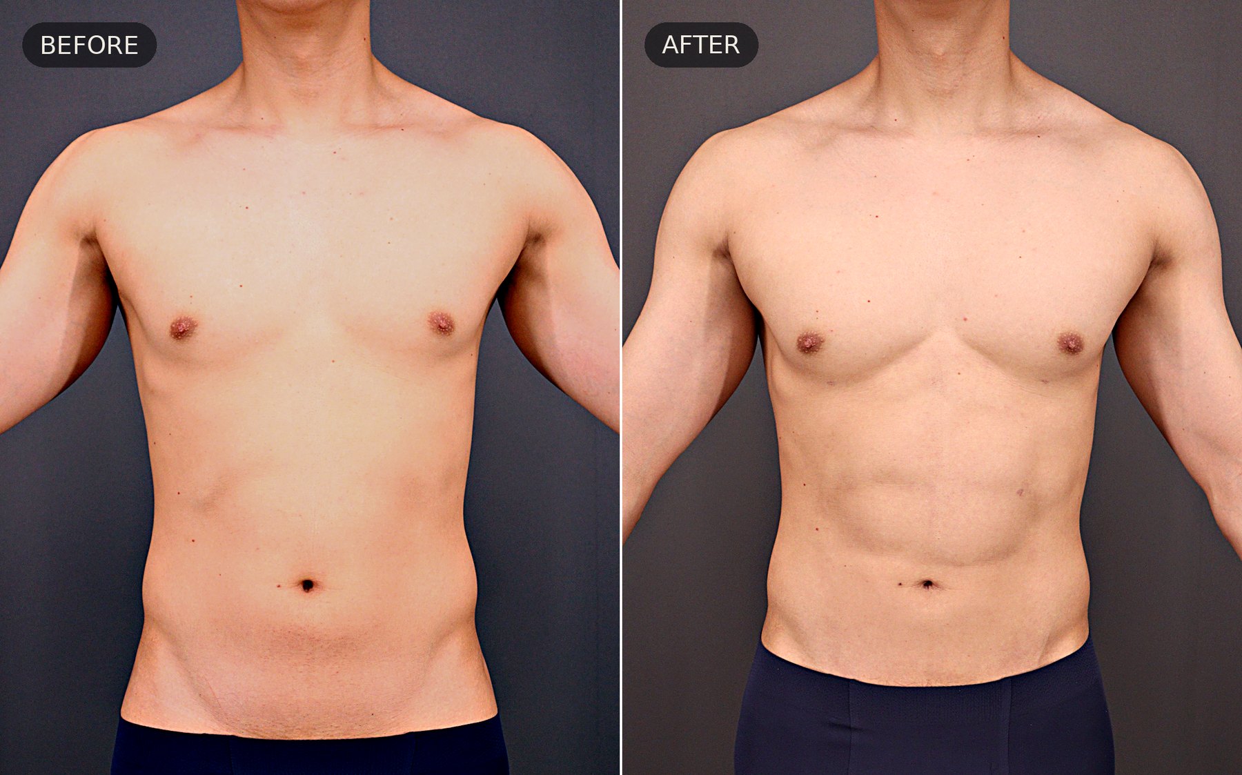 HD VASER liposuction — before and after